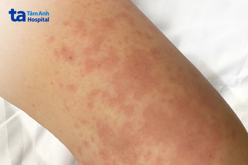 tình trạng bệnh của chị