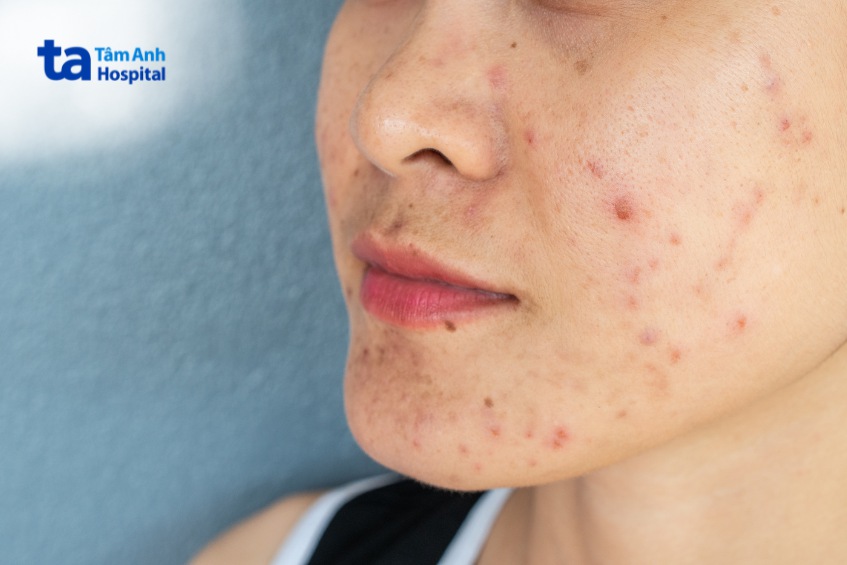 tình trạng da mụn nào có thể tiêm meso