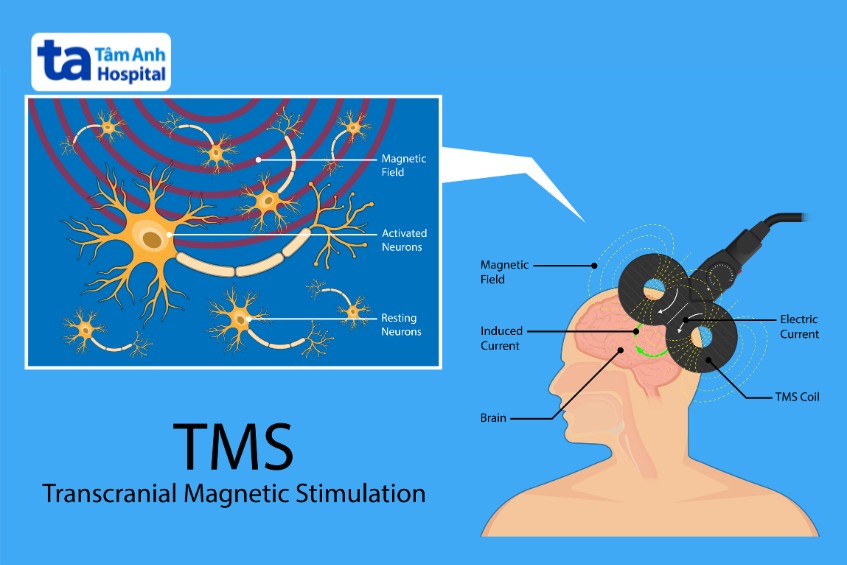 tms hỗ trợ phục hồi ngôn ngữ sau tai biến