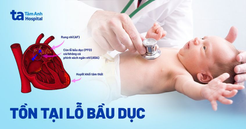 Bệnh tim tồn tại lỗ bầu dục (PFO): Nguyên nhân và cách điều trị