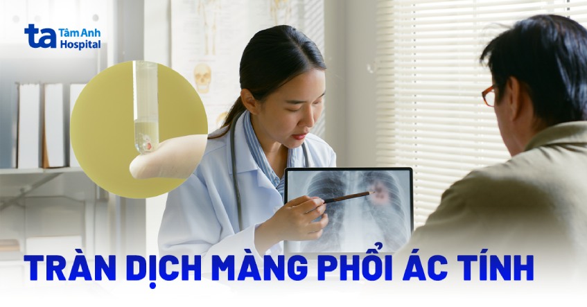Tràn dịch màng phổi ác tính: Nguyên nhân, triệu chứng, điều trị