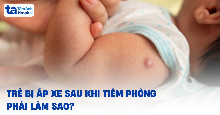 Trẻ bị áp xe sau khi tiêm phòng phải làm sao? Hướng dẫn cách xử trí