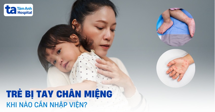 Trẻ bị tay chân miệng khi nào cần nhập viện? [Bác sĩ tư vấn]