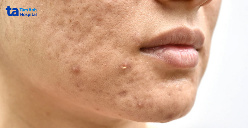 trị sai cách có thể để lại sẹo