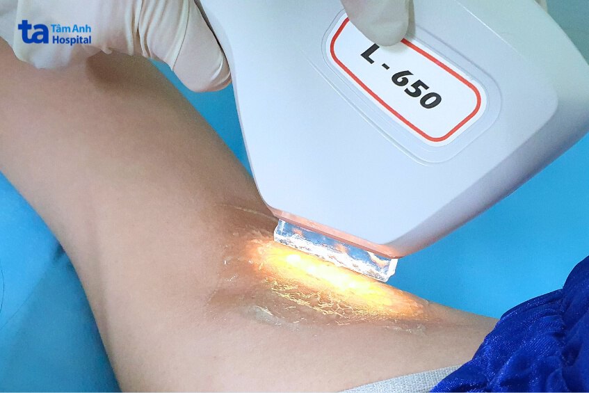 triệt lông bằng ánh sáng xung cường độ cao ipl