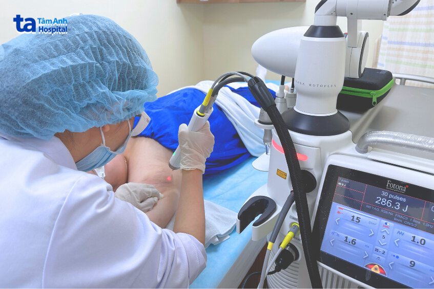 triệt lông nách vĩnh viễn tại tâm anh