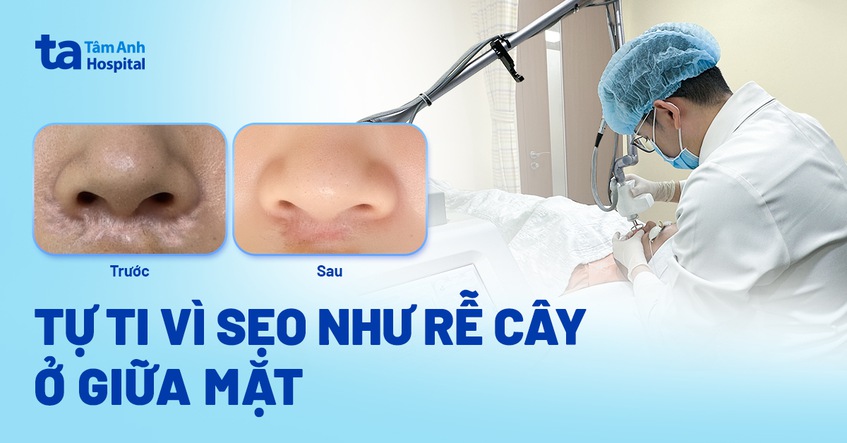tự ti vì sẹo như rễ cây ở giữa mặt