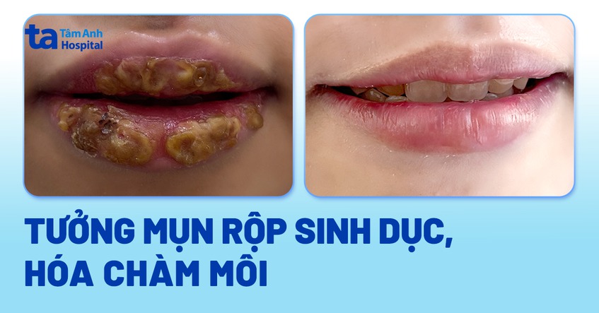 tưởng mụn rộp hóa chàm môi