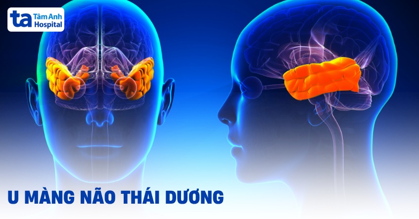 U màng não thái dương: Triệu chứng, nguyên nhân và cách điều trị