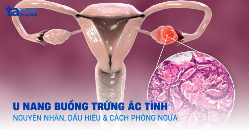 U nang buồng trứng ác tính: Nguyên nhân, dấu hiệu, phòng ngừa