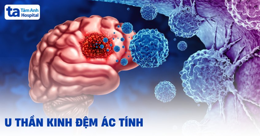 u thần kinh đệm ác tính