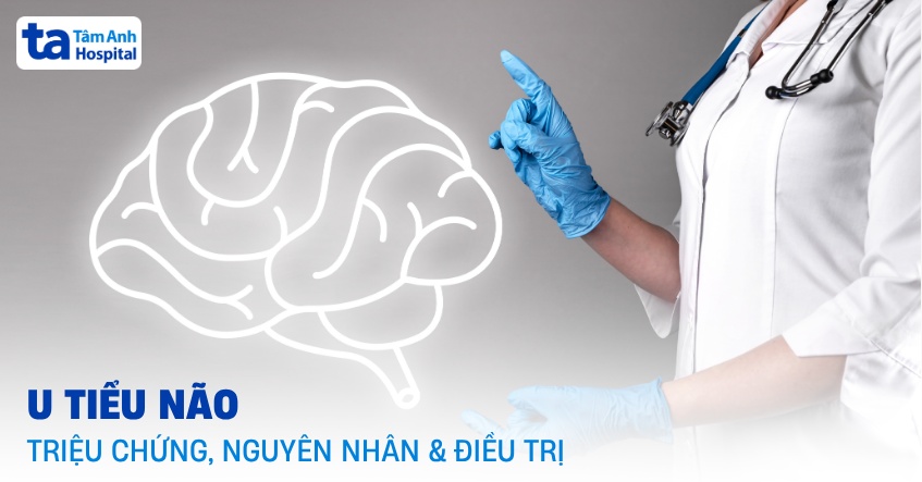 U tiểu não: Triệu chứng, nguyên nhân, chẩn đoán và điều trị