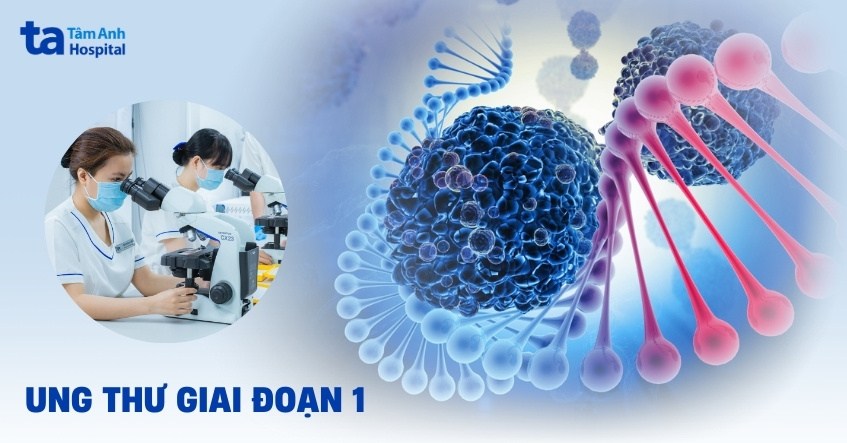 Ung thư giai đoạn 1 là gì? Dấu hiệu, chẩn đoán và điều trị