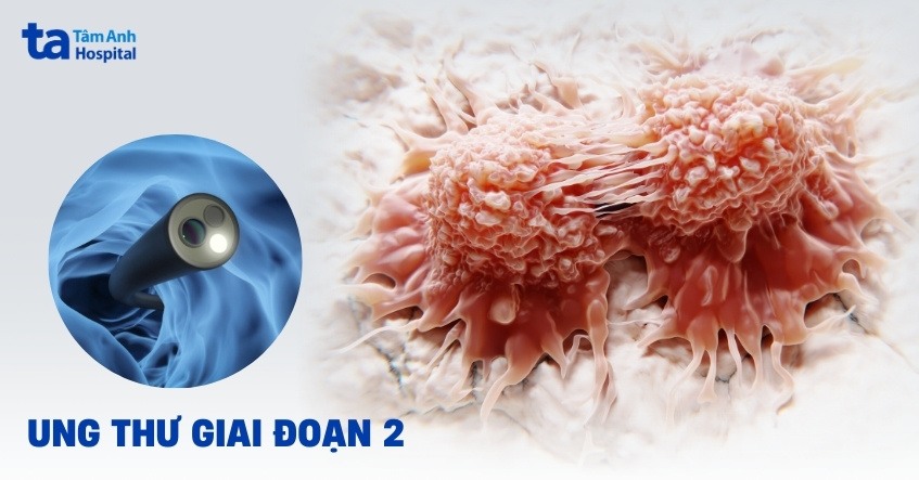 Ung thư giai đoạn 2: Dấu hiệu, chẩn đoán và cách điều trị