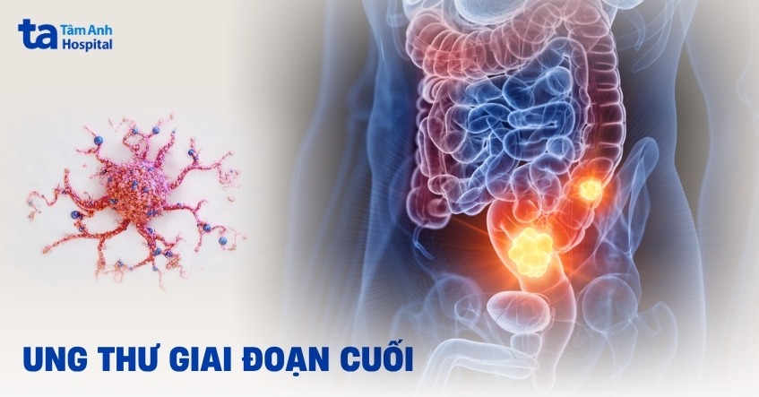 Ung thư giai đoạn cuối: Triệu chứng, chẩn đoán và điều trị