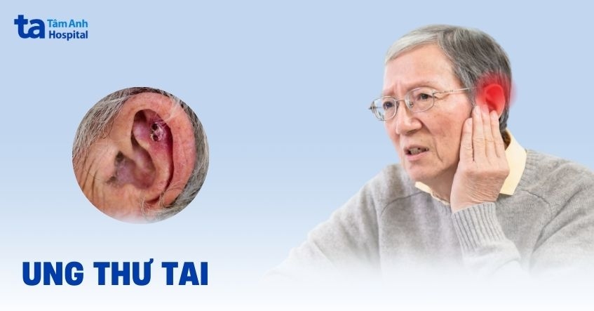 Ung thư tai: Nguyên nhân, triệu chứng và chẩn đoán bệnh