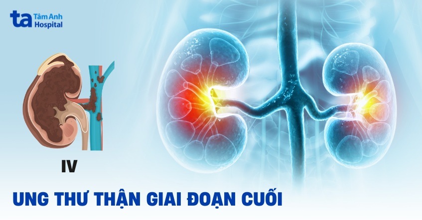 Ung thư thận giai đoạn cuối sống được bao lâu? Triệu chứng, điều trị