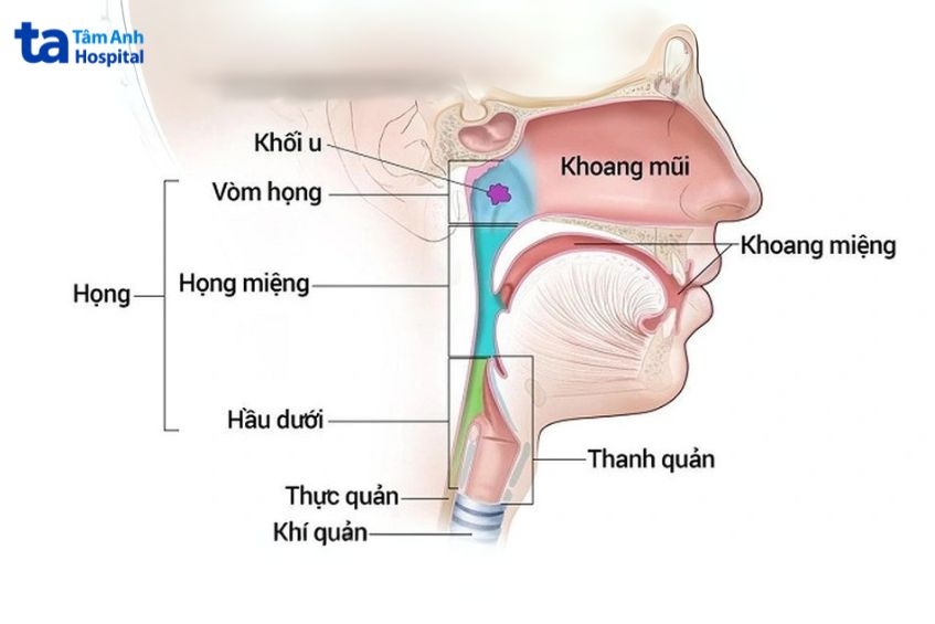 ung thư vòm mũi là gì