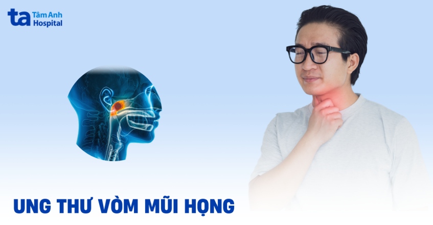 Ung thư vòm mũi họng làm sao để phát hiện? Làm gì để xử lý?