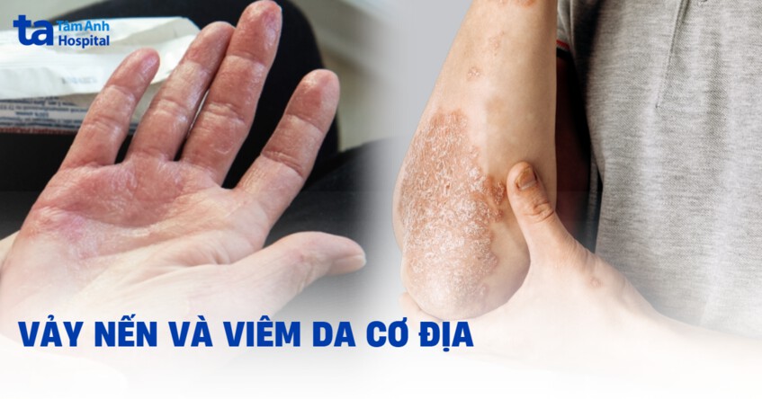 Vảy nến có phải viêm da cơ địa không? Phân biệt như thế nào?