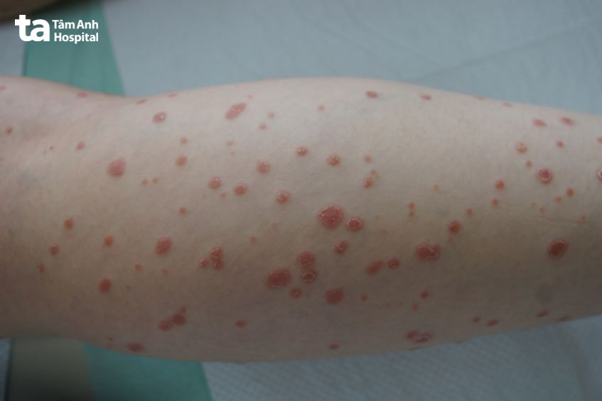 vảy nến thể giọt có cần kiêng gì không