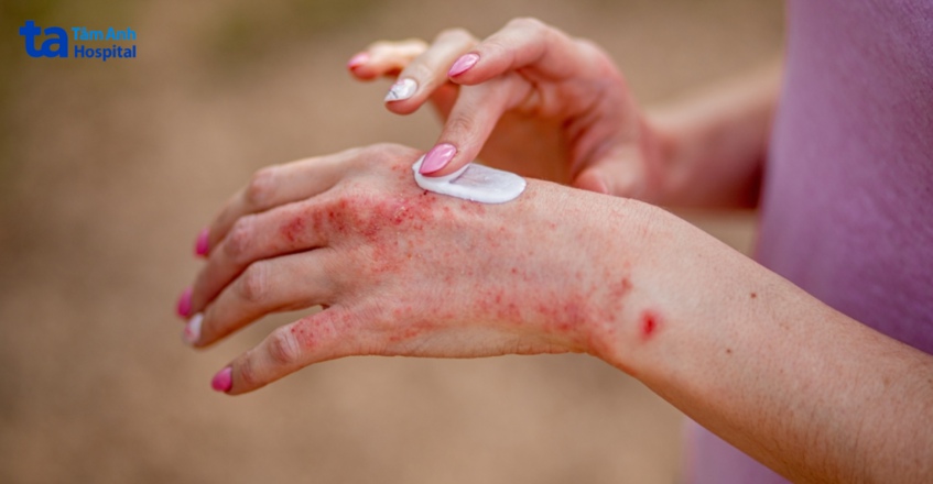 vảy nến và viêm da cơ địa ảnh