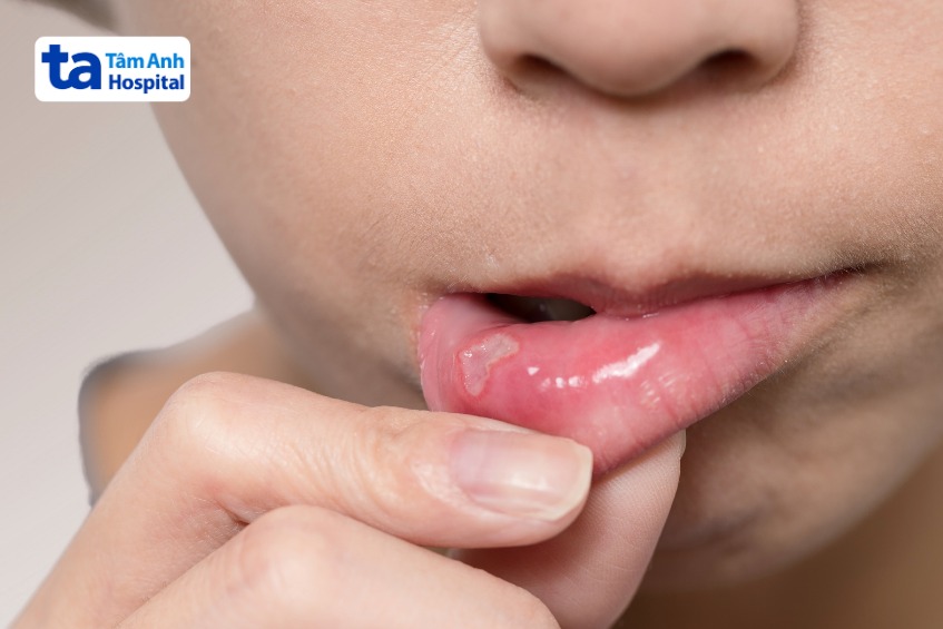 vết loét tay chân miệng lớn gây đau cho trẻ