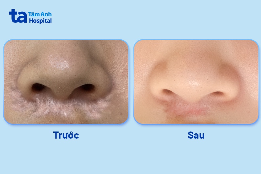 vết sẹo đã đều màu và mờ hơn