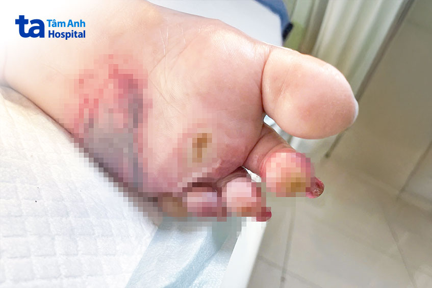 vết thương bàn chân của người tiểu đường