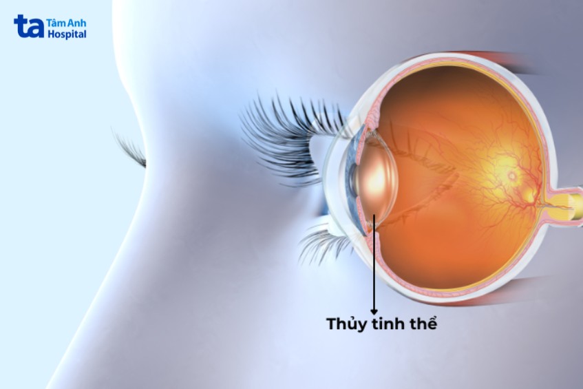 vị trí thủy tinh thể ở mắt