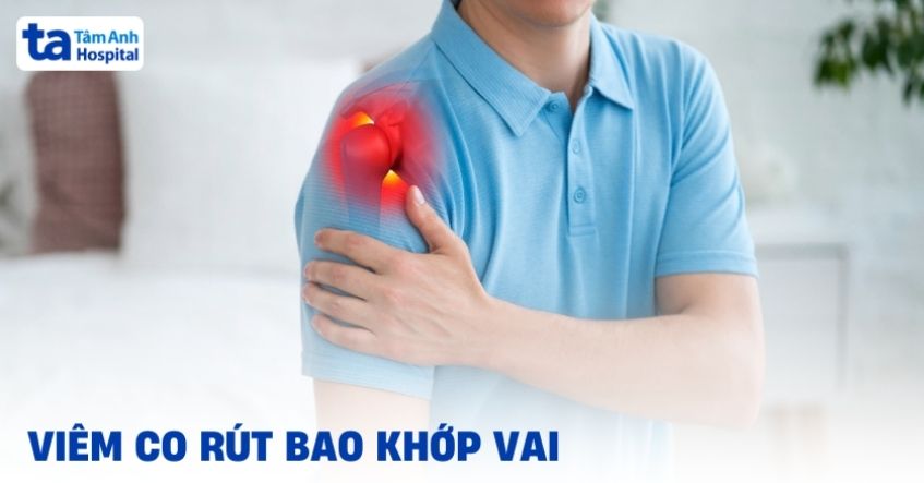 Viêm co rút bao khớp vai: Nguyên nhân, dấu hiệu, cách điều trị
