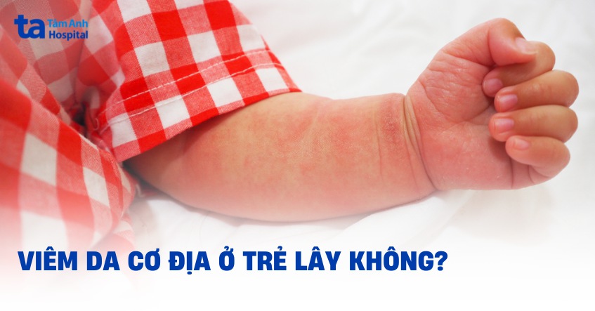 Viêm da cơ địa ở trẻ em có lây không? Có lan ra xung quanh không?