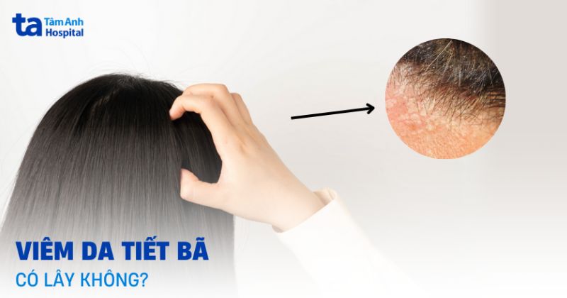 viêm da tiết bã có lây không