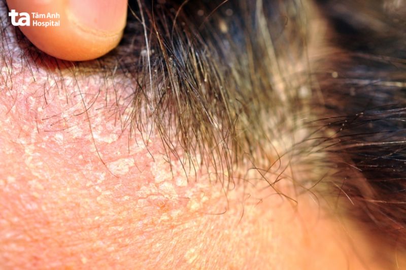 viêm da tiết bã thường mỏng và có máu trắng