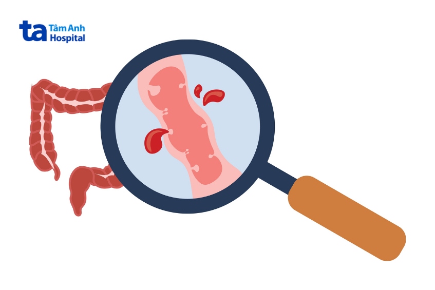 viêm đại tràng có nguy hiểm hay không