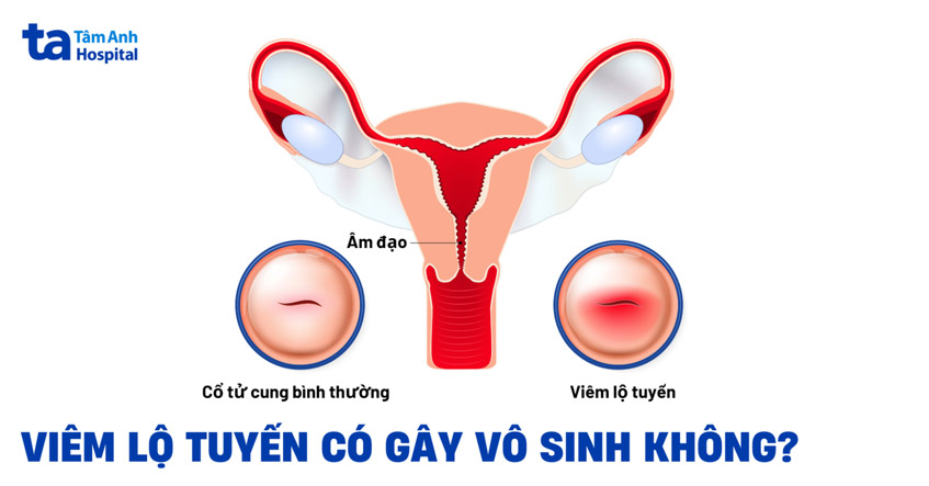 Viêm lộ tuyến có gây vô sinh không? Cần làm gì nếu muốn mang thai?