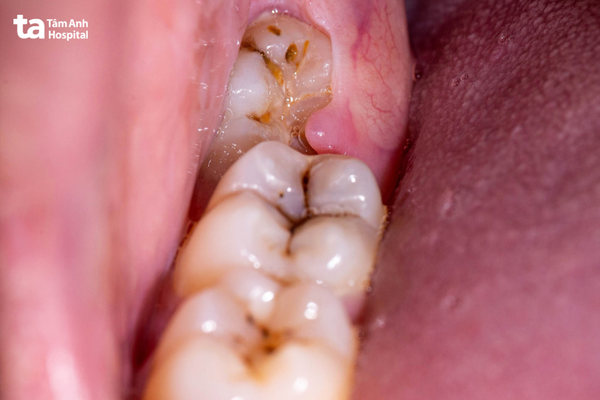 viêm lợi có nhổ được răng khôn không