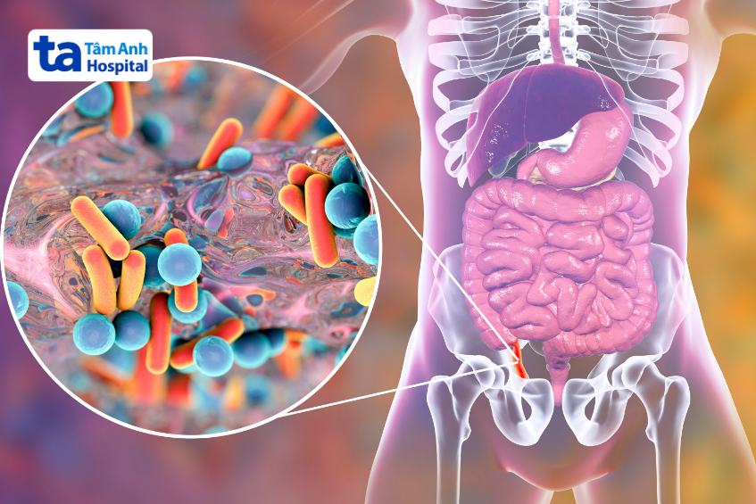 viêm ruột thừa cấp ở trẻ em có thể xảy ra không rõ nguyên nhân