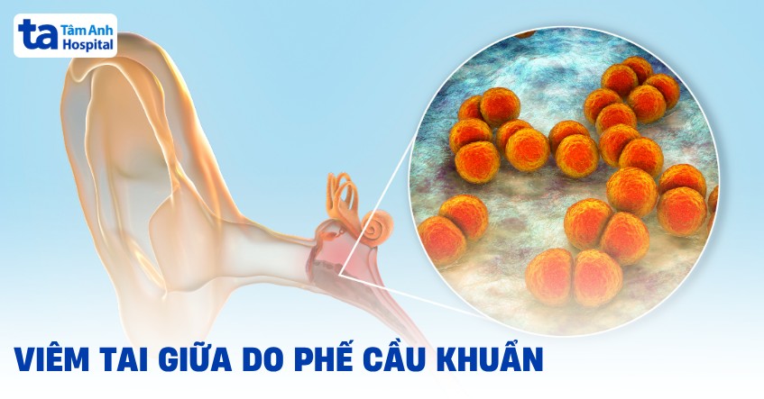 viêm tai giữa do phế cầu khuẩn