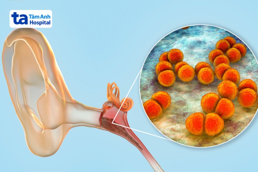 viêm tai giữa do vi khuẩn phế cầu