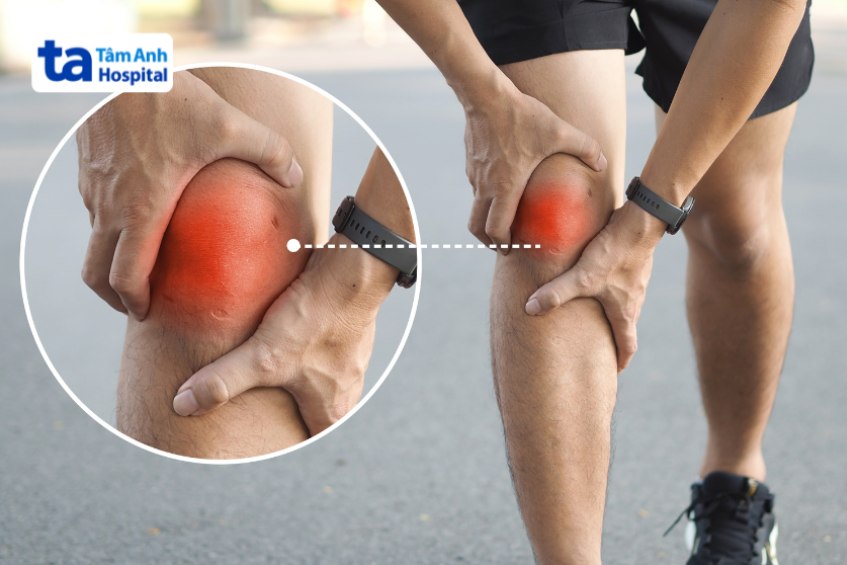 Vỡ mâm chày là gì?