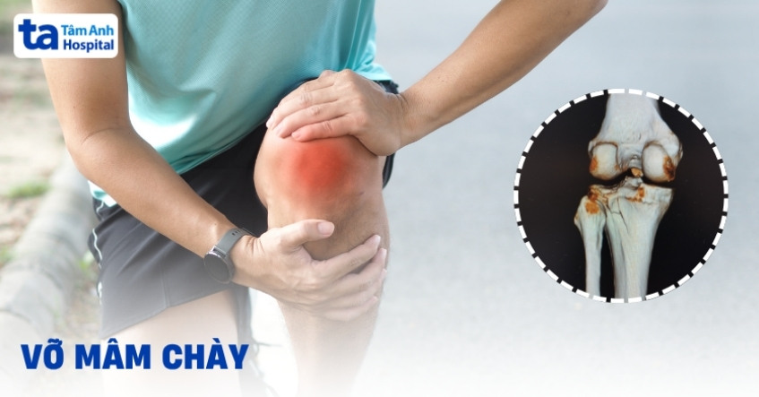 Vỡ mâm chày khớp gối có nguy hiểm không? Điều trị như thế nào?