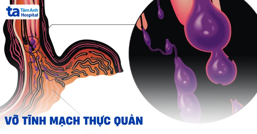 Vỡ tĩnh mạch thực quản có nguy hiểm không? Cấp cứu, điều trị