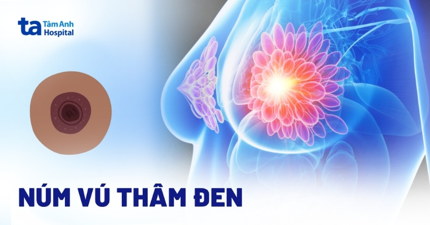Núm vú thâm đen có sao không? Nguyên nhân và cách trị