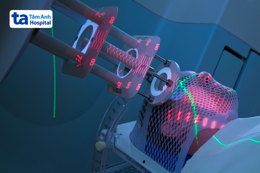 xạ trị điều trị u màng não