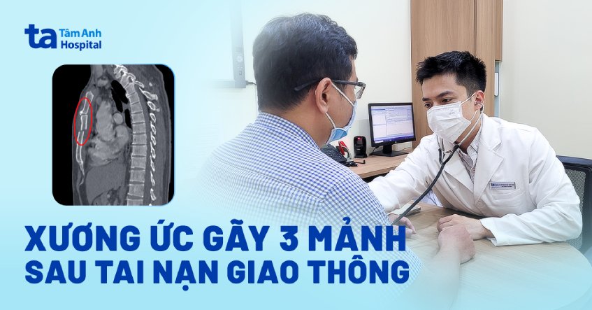 Xương ức gãy 3 mảnh sau tai nạn giao thông