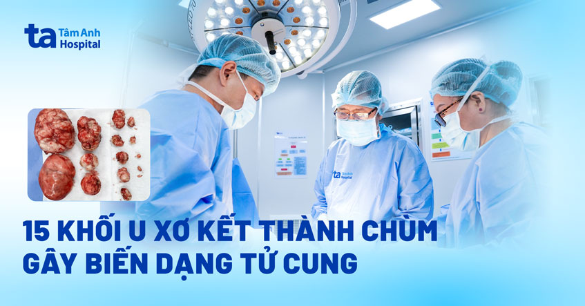 15 khối u xơ kết thành chùm trong tử cung