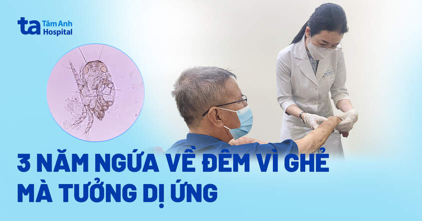 3 năm ngứa về đêm vì ghẻ tưởng dị ứng