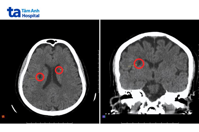 ảnh ct nhồi máu não