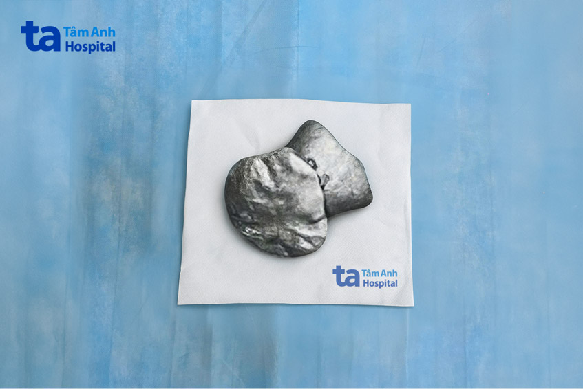 ảnh dị vật được lấy ra khỏi vùng hàm của em bé